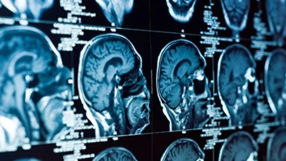 Científicos de Harvard descubrieron cuál es el inicio del deterioro cognitivo 