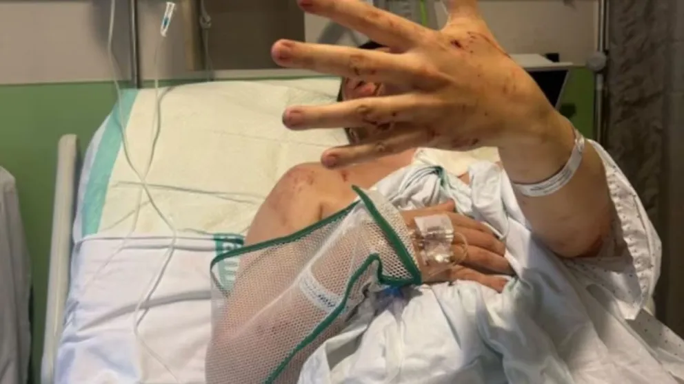 Las secuelas del accidente que padeció el sanjuanino Jeremías Conte Grand, quien se encuentra internado en el Hospital de Toledo. (Gentileza: Corriere della Serra)